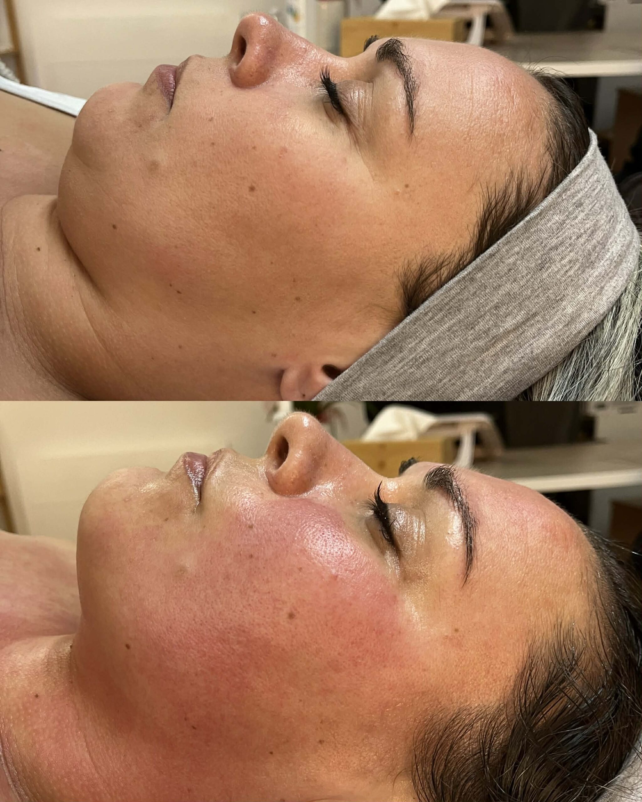 Avant après visage drainage